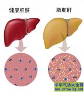 年轻人也脂肪肝 保肝有妙招