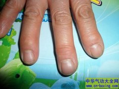 手指肿胀 可能是这六大原因