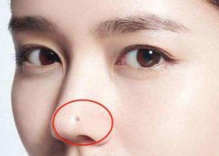 女人鼻子的两边有痣好不好？鼻子上长痣的女明